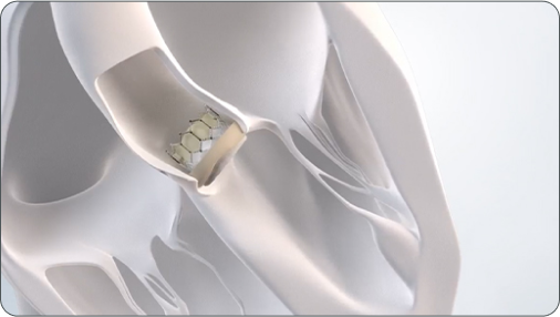 Video thumbnail: How Is TAVR Performed